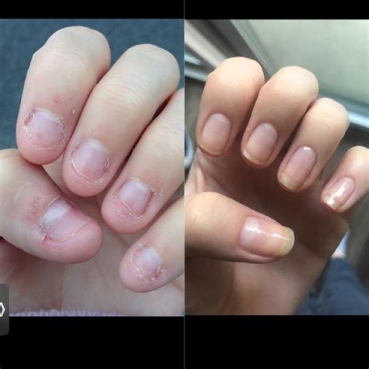 Can you grow your nail bed?