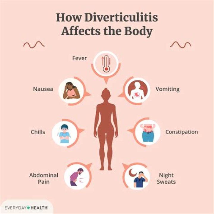 Can you have diverticulitis without fever?
